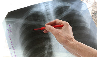 Россию ждет всплеск туберкулеза Россию ждет всплеск туберкулеза