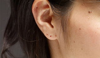 Родинки влияют на продолжительность жизни Родинки влияют на продолжительность жизни