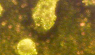 Золотые нанобомбы помогут в лечении рака Золотые нанобомбы помогут в лечении рака