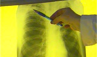 Девушке пересадили "бракованные" легкие Девушке пересадили "бракованные" легкие