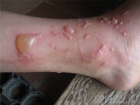 Брянщину атаковал борщевик Ожоги от борщевика