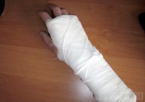 Горе-грабитель сломал руку, перелезая через забор