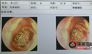 Паук пять дней прожил в ухе у женщины Паук пять дней прожил в ухе у женщины
