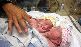 В Лондоне разделили сиамских близнецов В Лондоне разделили сиамских близнецов