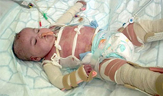 Обварившийся ребенок пережил 321 операцию Обварившийся ребенок пережил 321 операцию