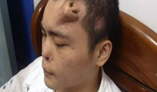 В Китае врачи вырастили нос на лбу пациента В Китае врачи вырастили нос на лбу пациента