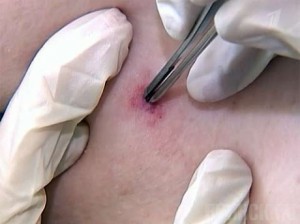 На Брянщине число укушенных клещами увеличивается