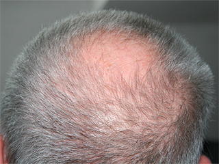 В США испытали таблетки от облысения В США испытали таблетки от облысения