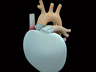 Человеку пересадили искусственное сердце Человеку пересадили искусственное сердце
