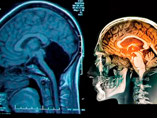 Китаянка прожила 24 года без мозжечка Китаянка прожила 24 года без мозжечка