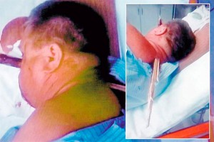 Поляк пришел к врачу с колом в голове Поляк пришел к врачу с колом в голове