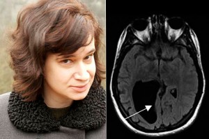 У американки нашли дыру в мозге с лимон У американки нашли дыру в мозге с лимон