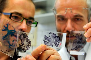 Болезнью Альцгеймера можно заразиться Болезнью Альцгеймера можно заразиться