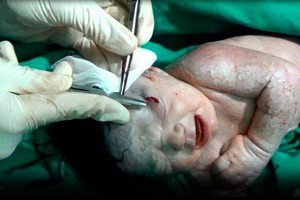 В Сирии родился ребенок со снарядом в голове В Сирии родился ребенок со снарядом в голове