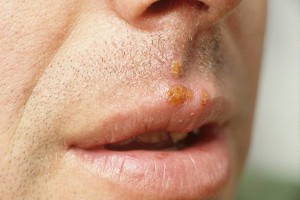 Герпес связали с болезнью Альцгеймера Герпес связали с болезнью Альцгеймера